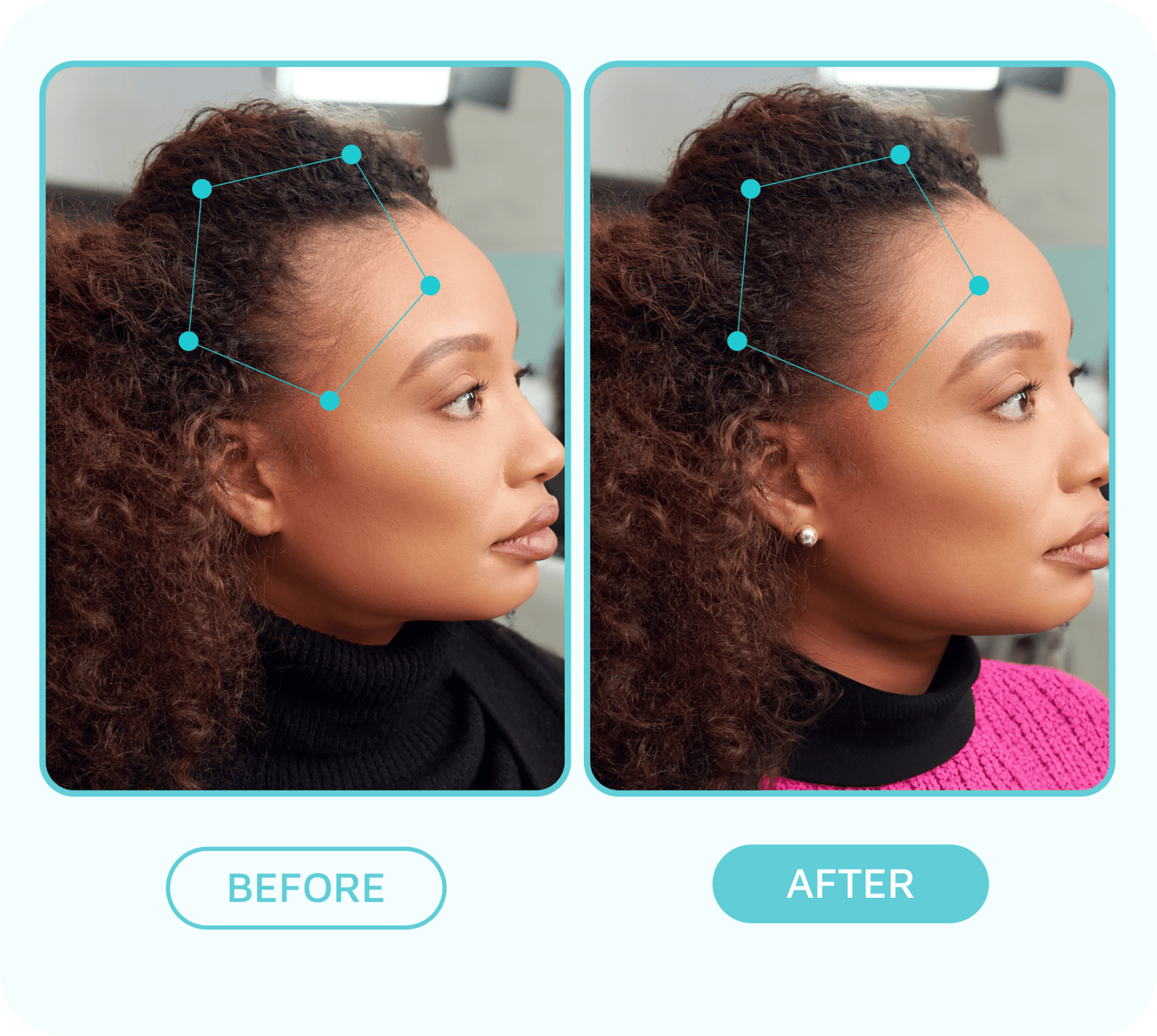 Side-by-side before and after profile of a woman showing improved hairline growth, highlighted by blue dots and lines; labeled "BEFORE" and "AFTER."